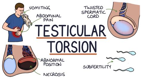 Testicular torsion 